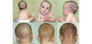 Torticollis