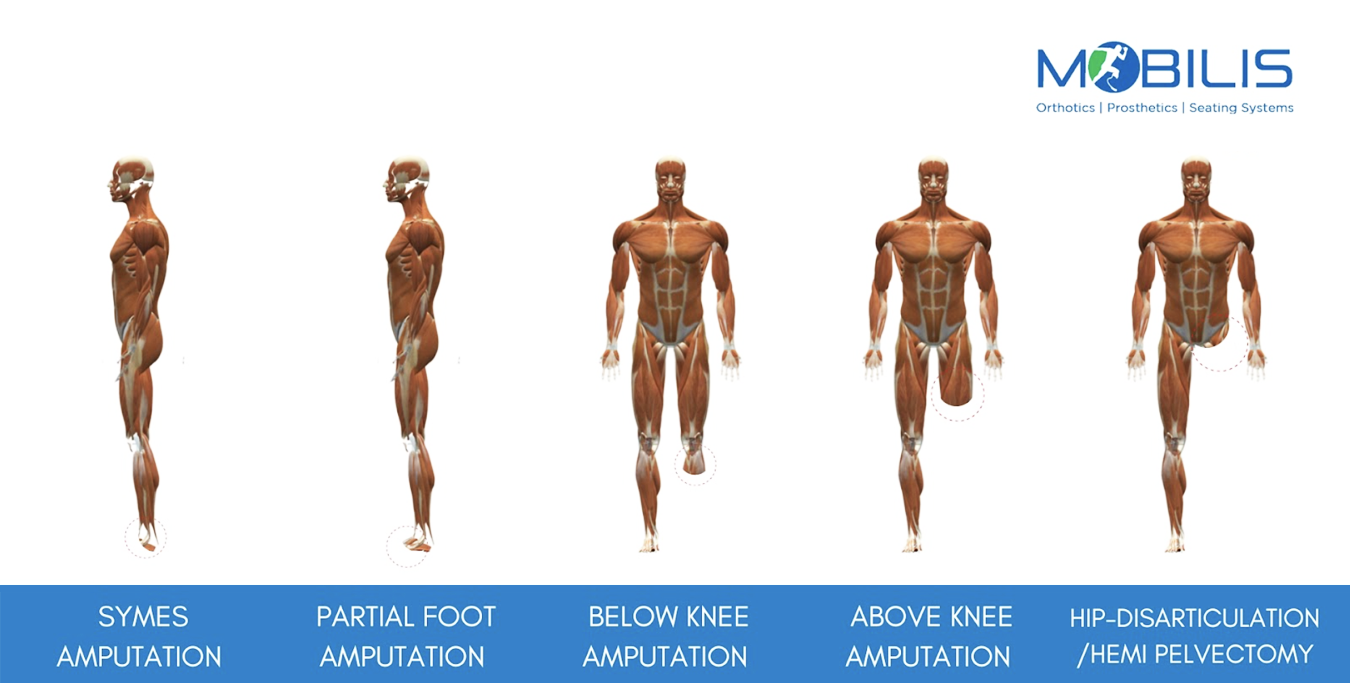 Surgical Type Below Knee Legs Prosthesis, For Medical, Prostheses Leg